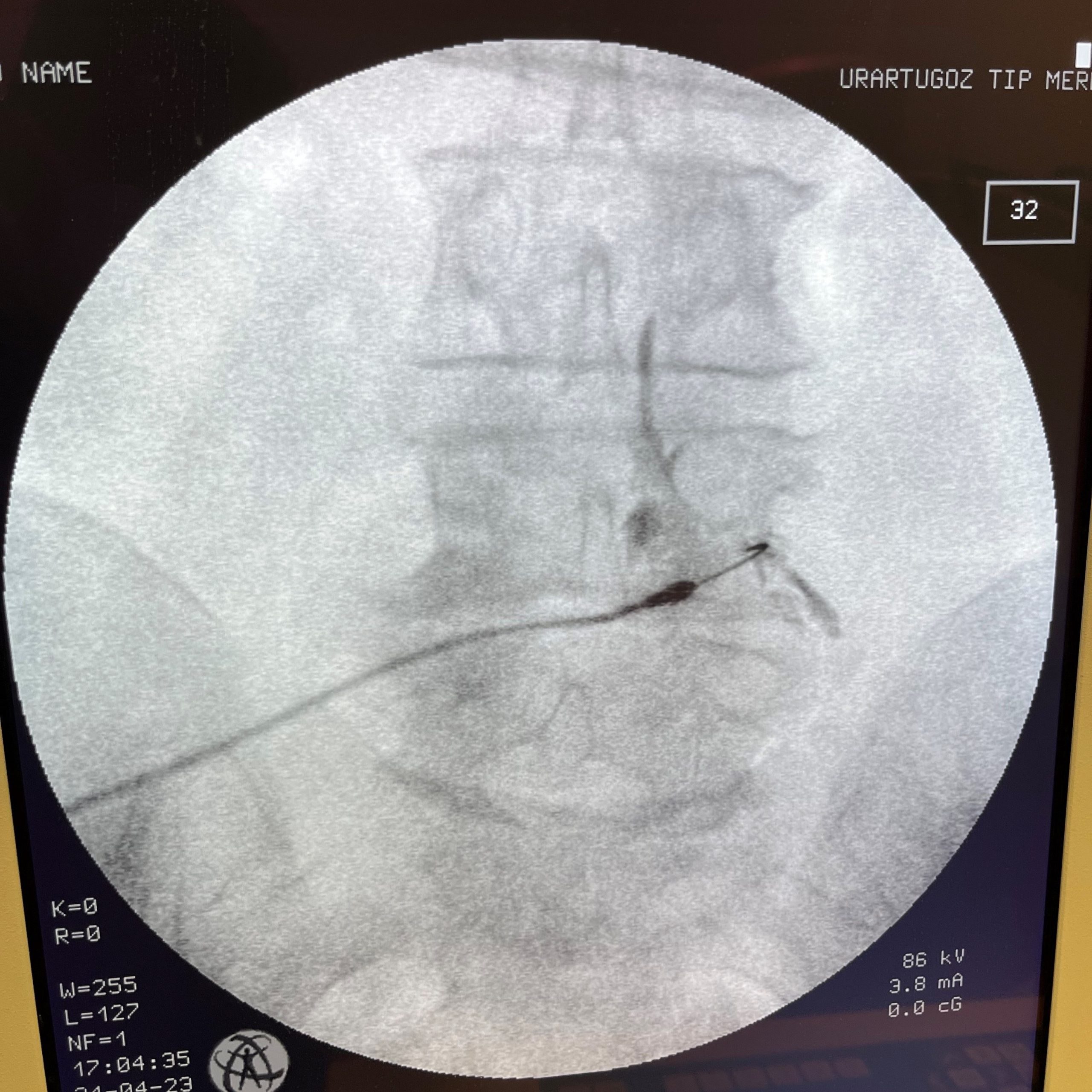 sinir kanalı enjeksiyonu